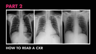 ABCs of Reading a Chest X-ray - How to Read a Chest X-Ray (Part 2) - MEDZCOOL