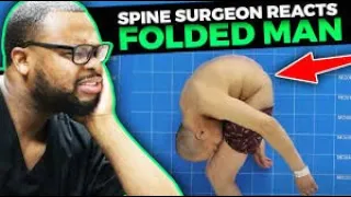 Lived folded Man for 28 years Stand up straight after Bone breaking surgery believable!!!