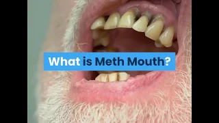 What is Meth Mouth?