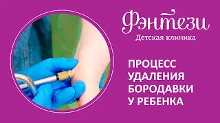 🔎  Процесс удаления бородавки у ребенка