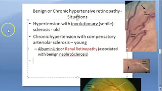 Ophthalmology 282 b Benign Chronic Hypertensive Retinopathy Salu Bonnet Gunn Sign Copper Wiring
