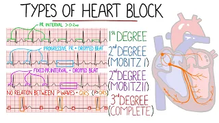 Heart Blocks Made Easy - 1st, 2nd (Mobitz 1/Wenckebach & Mobitz 2), 3rd (Complete) | with ECGs