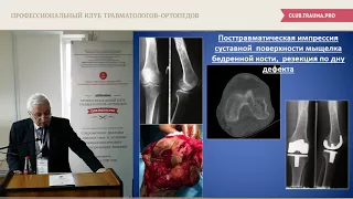 Первичное эндопротезирование коленного сустава при костных дефектах.