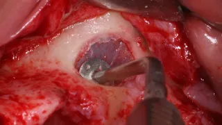 Direct Sinus Lift