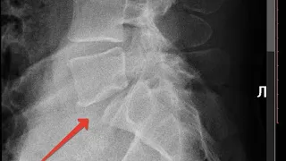 Лечение спондилолизного спондилолистеза