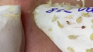 Blackheads and whiteheads removal (338)