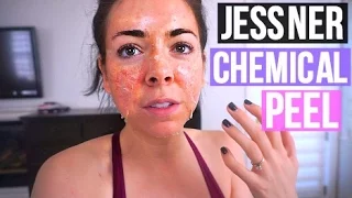 NIKKI GETS A NEW FACE! Jessner Chemical Peel Review! Before and After!