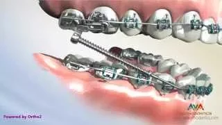 Different Types of Forsus - Orthodontic Appliance