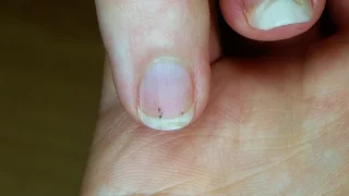 The Basics: How to Remove a Splinter | WebMD