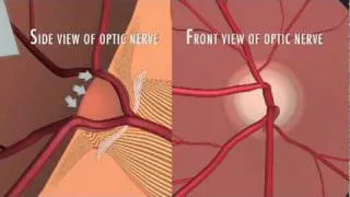 Optic Nerve Fibers