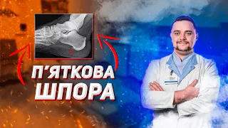 П'яткова шпора. Чому болить і як лікувати.