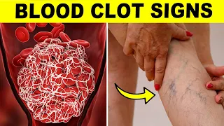 Warning Signs Of A Blood Clot That Can’t Be Ignored