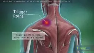 Myofascial pain syndrome and trigger points. Reasons