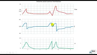 Patient ventilator Asynchrony: Double Triggering