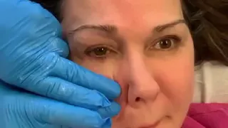 Lip Rolling Exercises for Eye Synkinesis