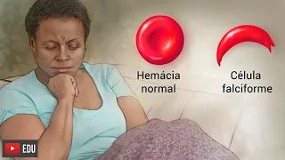 Anemia falciforme: o que é, sintomas, causas e tratamento