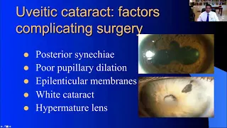 Management of Cataracts in Uveitis Patients