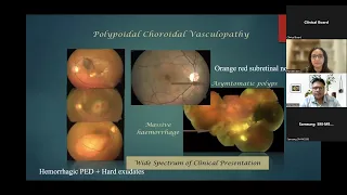 PCV Treatment Paradigms