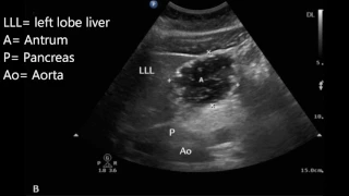 Gastric ultrasound for preoperative assessment