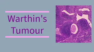 Warthin's tumour  | Factors | Clinical features | Gross | Histological findings