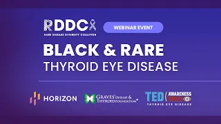 Black & Rare: Thyroid Eye Disease