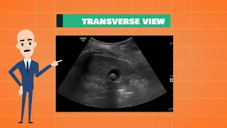 Gall stones on ultrasound I POCUS pearls I Dr. Koratala @NephroP