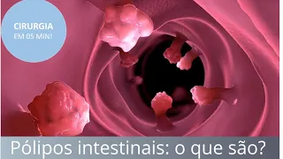 Pólipos intestinais: o que são, como diagnosticar e tratar? | Fernando Eyer