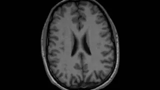 MRI of the brain while dreaming