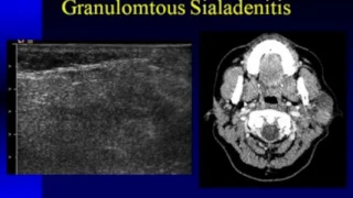 Ultrasound Imaging of the Salivary Glands