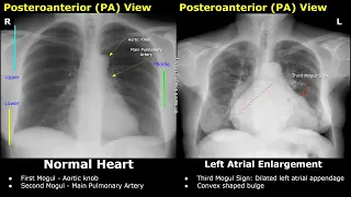 Chest X-Ray Heart Normal Vs Abnormal Image Appearances | Cardiac Diseases On Radiography (CXR)