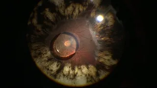 VITRECTOMY