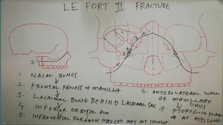 LE FORT-II FRACTURE LINE