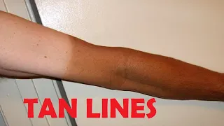 how to get rid of tan lines on arms naturally