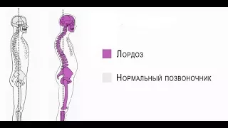 Как исправить гиперлордоз