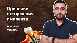 Зубной имплантат не прижился. Признаки + кейс отторжение импланта спустя 10 лет.