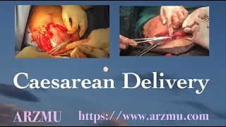 C-section (Cesarean Section) | Caesarean Delivery | All steps in a Cesarean Delivery