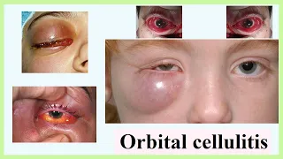 orbital cellulitis