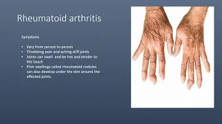 13 C ? D Musculoskeletal malfunctions voice over ppt (classwork)