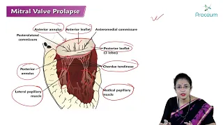 Mitral Valve Prolapse (Hindi) : Etiology, Clinical Features, Diagnosis, Treatment, Complications 🫀🫀🫀