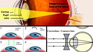 MYOPIA | SHORT SIGHTEDNESS | ERRORS OF REFRACTION