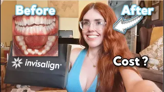 INVISALIGN - Everything You Need To Know, My Honest Experience, FAQ's, Tips, Before & After