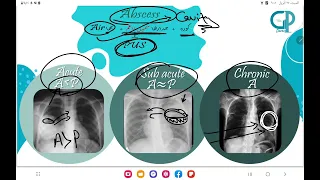 8- Lung lesions ( abscess )