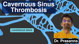 Cavernous Sinus Thrombosis (CST)