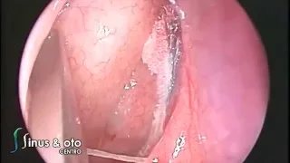 Orbital Fracture - Endoscopic Reconstruction of Lamina