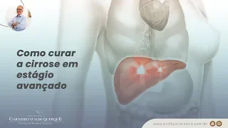 Como curar a cirrose em estágio avançado | Prof. Dr. Luiz Carneiro CRM 22761