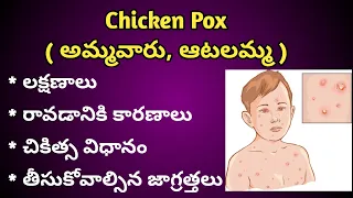 Chicken Pox ( అమ్మ వారు, ఆటలమ్మ ) causes, Symptoms and Treatment in Telugu