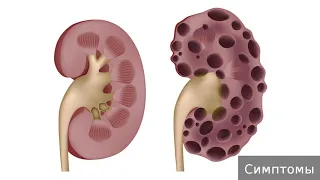 Поликистоз почек. Как лечить поликистоз почек.