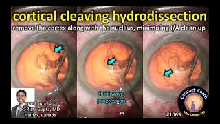 CataractCoach 1065: cortical cleaving hydro-dissection in cataract surgery