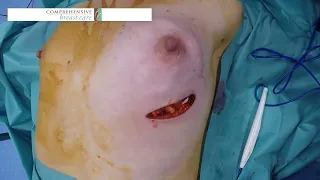 PREPECTORAL RECONSTRUCTION AFTER NIPPLE-SKIN MASTECTOMY (FOLLOWING NEOADJUVANT CHEMOTHERAPY)