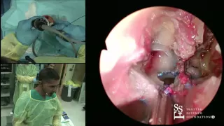 Sella Turcica, Suprasellar Approach & Cavernous Sinus Demonstration by Rick Chandra, MD